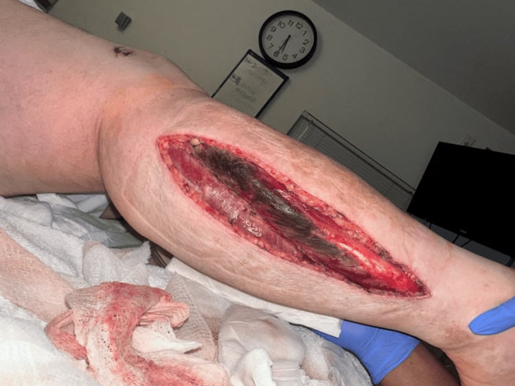 Open lateral fasciotomy wound with visibly necrotic muscle.