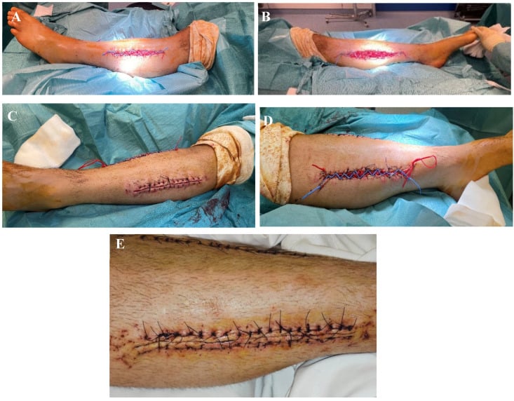 Serial clinical photographs showing medial and lateral shoelace closure with delayed definitive closure.