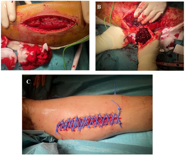 Intraoperative photographs showing lateral and medial leg fasciotomy incisions and a shoelace closure.
