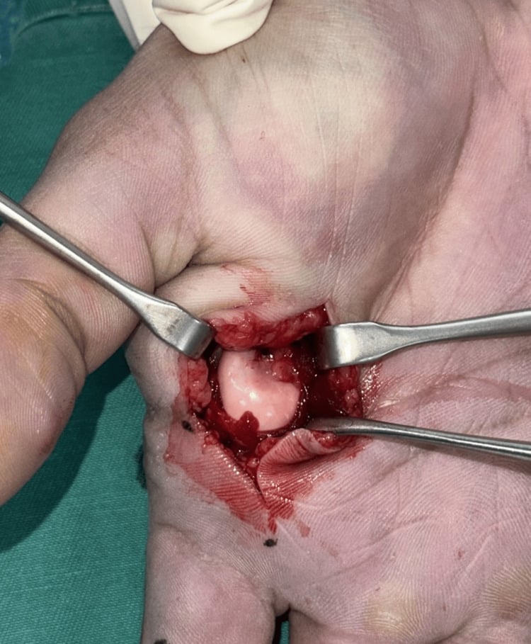 Volar approach to the index metacarpophalangeal joint showing the second metacarpal head buttonholed through the soft tissues