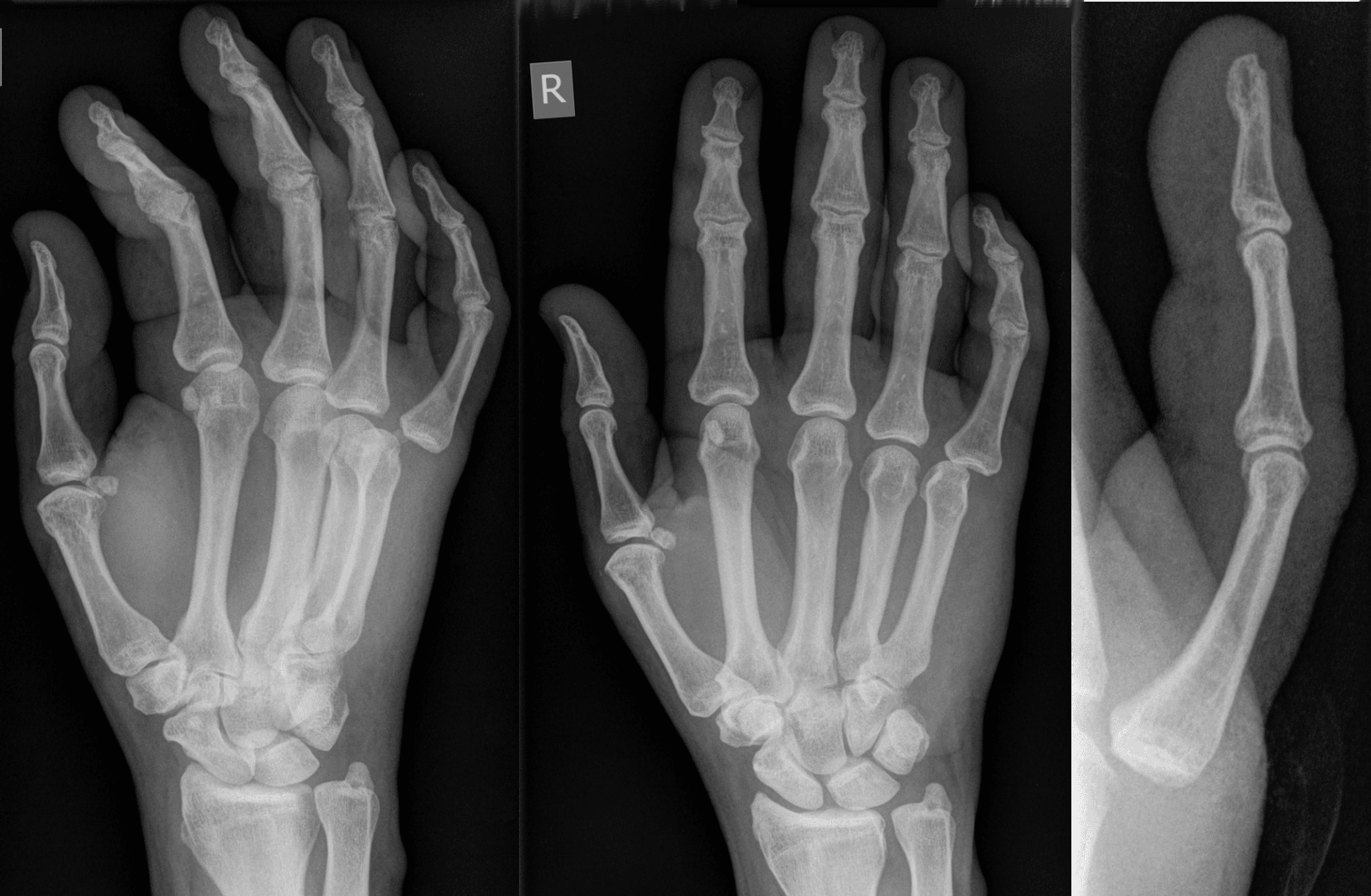 Three radiographic views of a right hand showing a metacarpophalangeal joint dislocation of the little finger with dorsal displacement of the proximal phalanx.