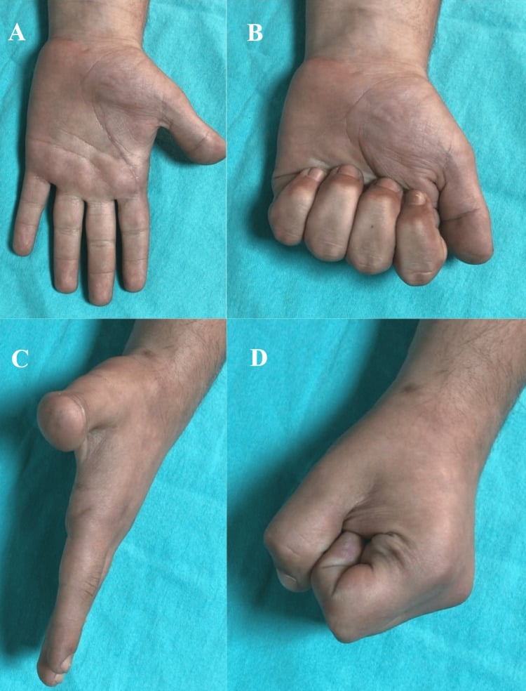Clinical photographs at twelve weeks showing normal flexion and extension at the metacarpophalangeal joint