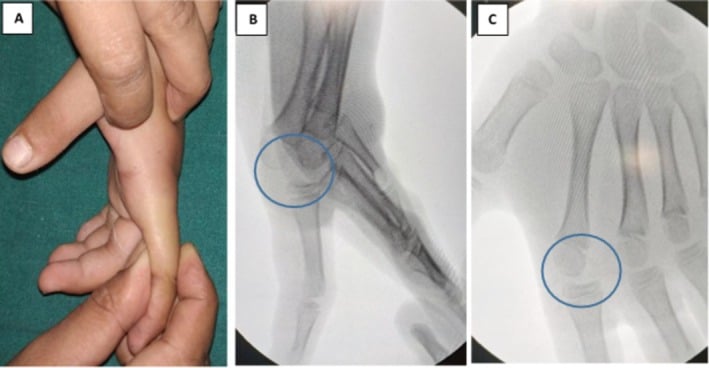 Preoperative clinical photograph and two radiographs of an index finger metacarpophalangeal joint dislocation with the joint circled