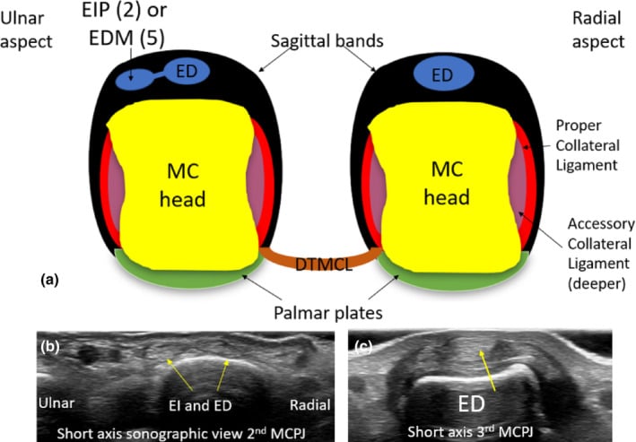 Short-axis diagram and ultrasound of the metacarpal head region labelling sagittal bands, proper and accessory collateral ligaments, palmar plate and deep transverse metacarpal ligament
