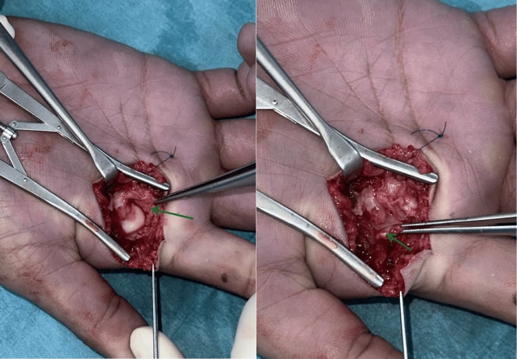 Intraoperative photograph showing division of the transverse metacarpal ligament identified with forceps