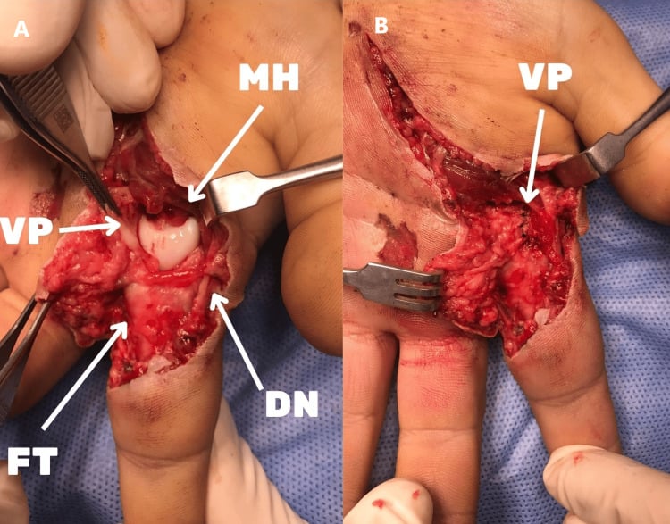 Intraoperative photographs labelling the metacarpal head, interposed volar plate, digital nerve and flexor tendon, then the repaired plate lying above the metacarpal head