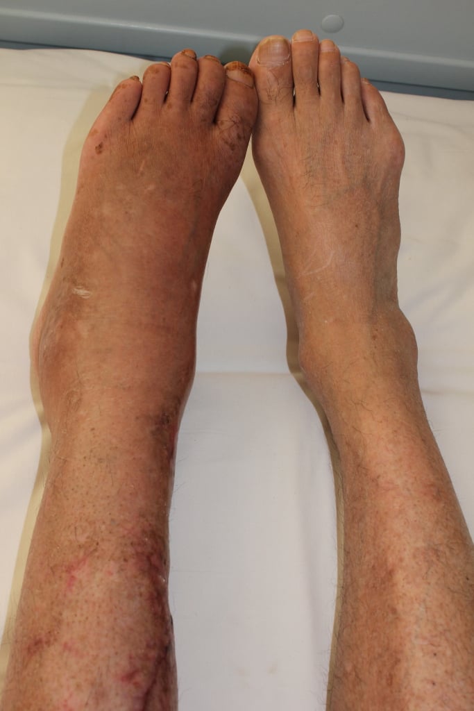 Clinical photograph comparing both lower legs and feet in Complex Regional Pain Syndrome