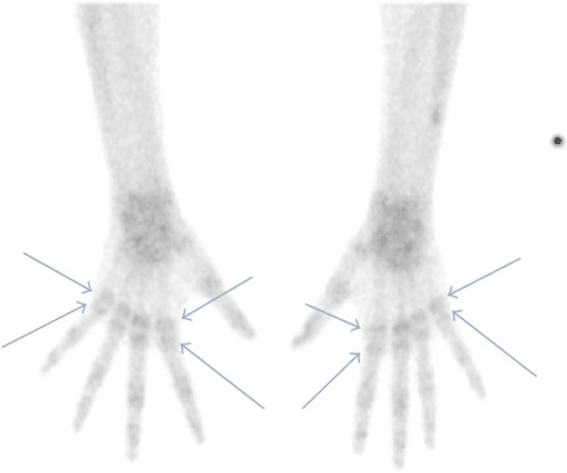 Delayed-phase bone scan of both hands with arrows marking periarticular tracer uptake.