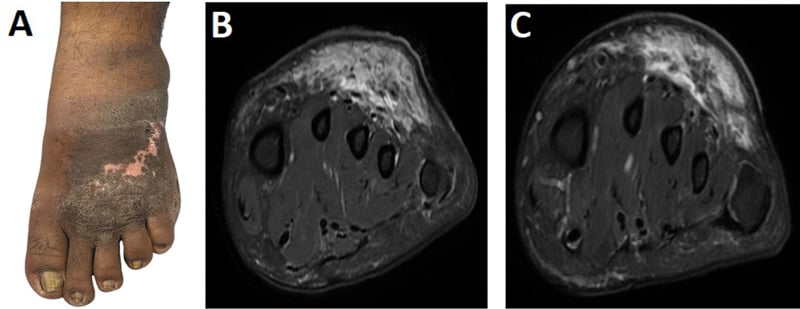 Clinical foot photograph (A) and two MRI images of the forefoot (B, C) showing skin change and soft-tissue signal change during evaluation of a CRPS mimic.