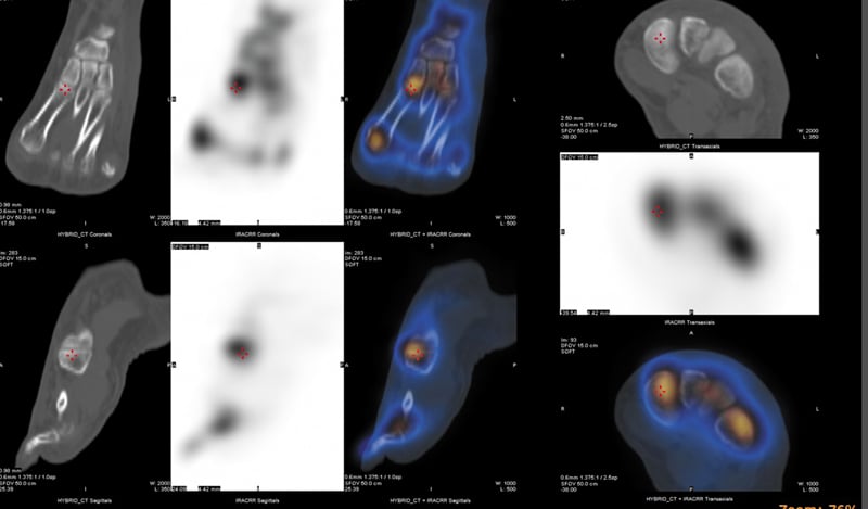Foot SPECT/CT with CT, nuclear and fused images in coronal, sagittal and transaxial planes localising regional tracer uptake.