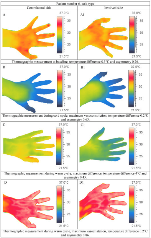 Paired thermographic images of the contralateral and involved hands of a cold-type CRPS patient at baseline and during cold and warm cycles.