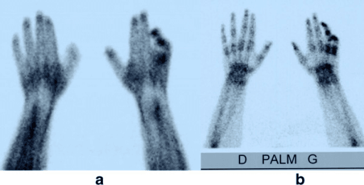Early and delayed hand bone scintigraphy (a, b) showing focal fourth- and fifth-finger uptake in partial CRPS.