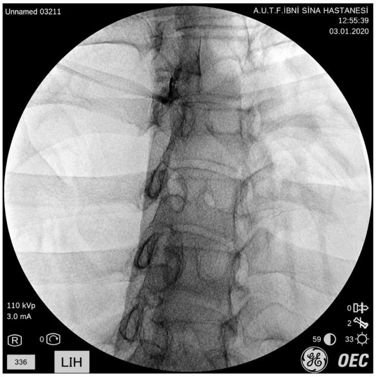 Fluoroscopic image of the thoracic spine showing contrast spread during a thoracic sympathetic block.