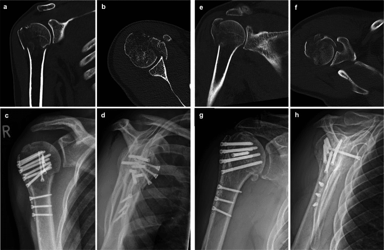 Radiographs and CT of a four-part proximal humerus fracture treated with a carbon-fibre-reinforced PEEK plate