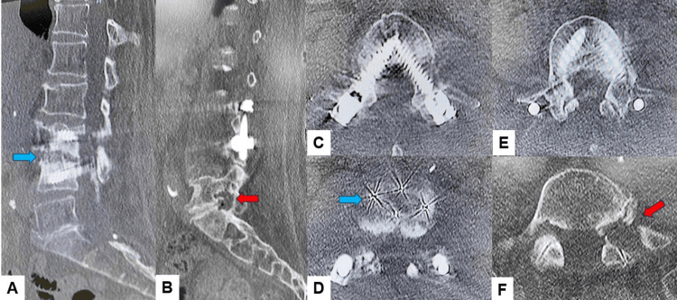 Multiplanar follow-up CT after lumbar interbody fusion showing a radiolucent PEEK cage and the surrounding fusion mass