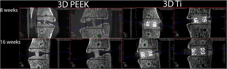 Micro-CT comparison of 3D-printed PEEK and titanium interbody cages at eight and sixteen weeks showing the PEEK cage is radiolucent while bone graft maturation remains visible
