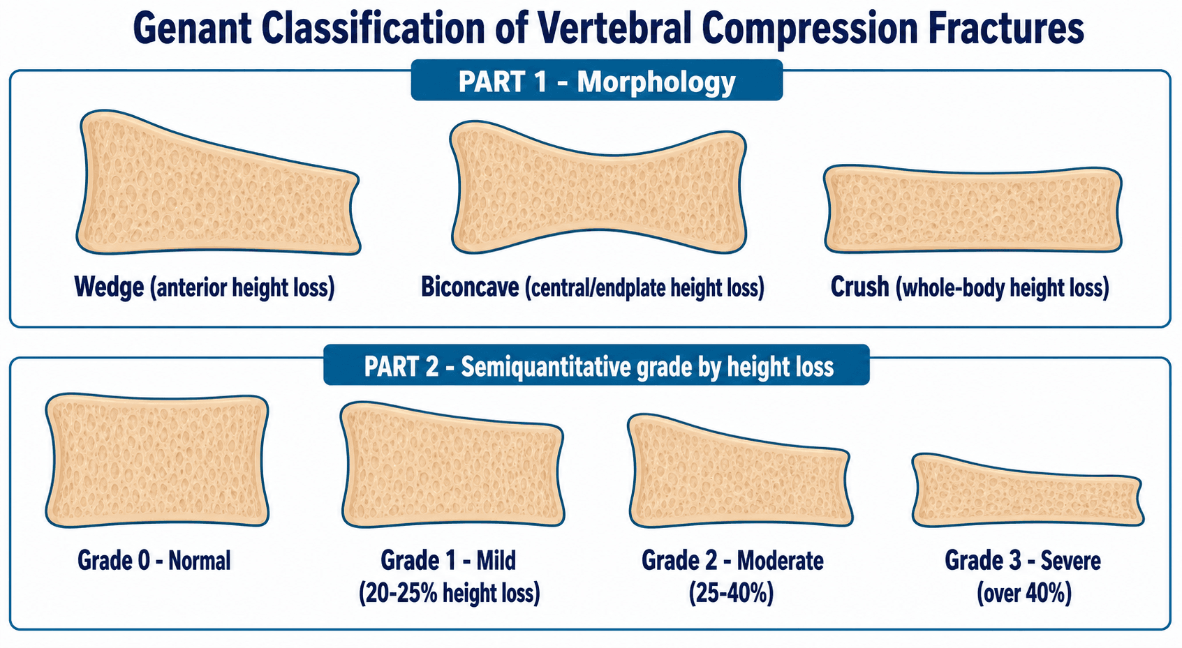 Genant classification of vertebral compression fractures: wedge, biconcave and crush morphology and grades 0 to 3 by height loss.