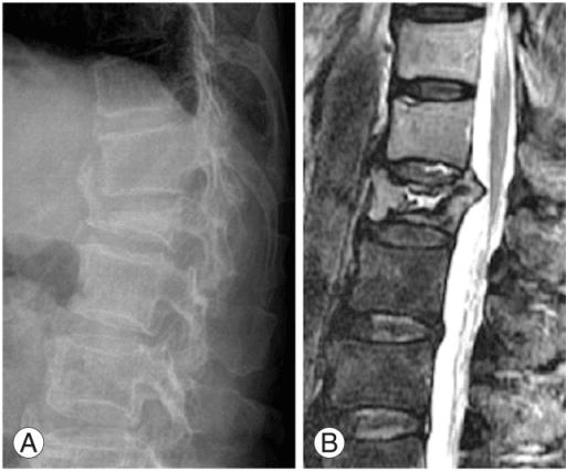 Vertebral compression fracture on X-ray and MRI comparison