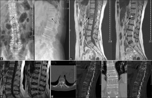 Balloon kyphoplasty case showing pre and post-operative imaging