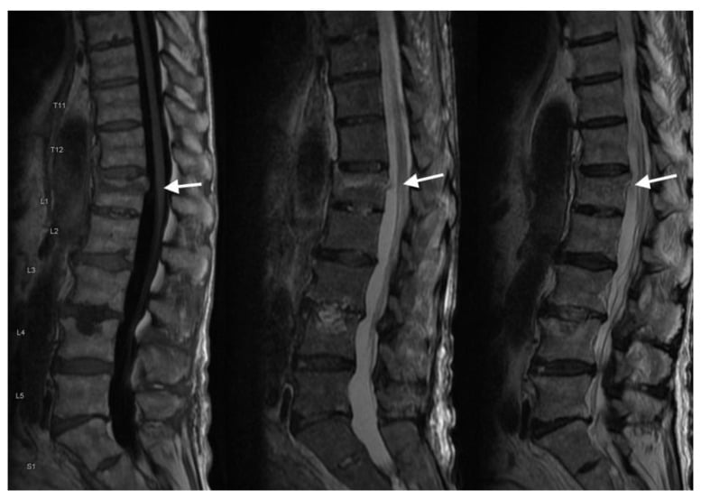 Investigation MRI sequences showing an acute L1 vertebral compression fracture with T1 low and STIR high marrow signal.