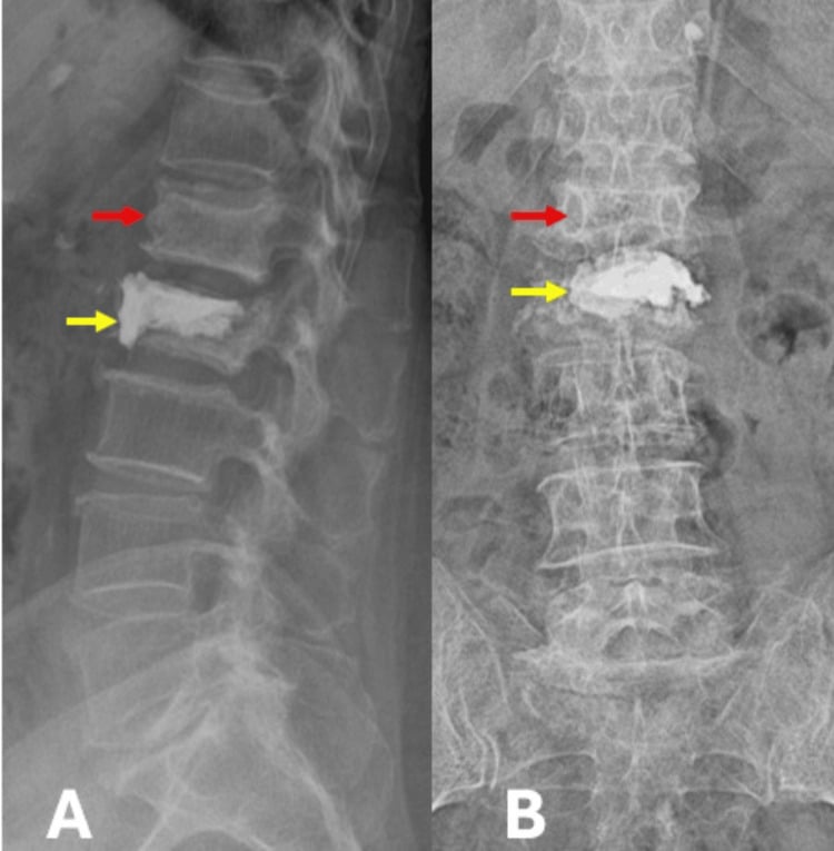 Complication radiographs showing an adjacent L1 compression fracture above an L2 vertebroplasty.