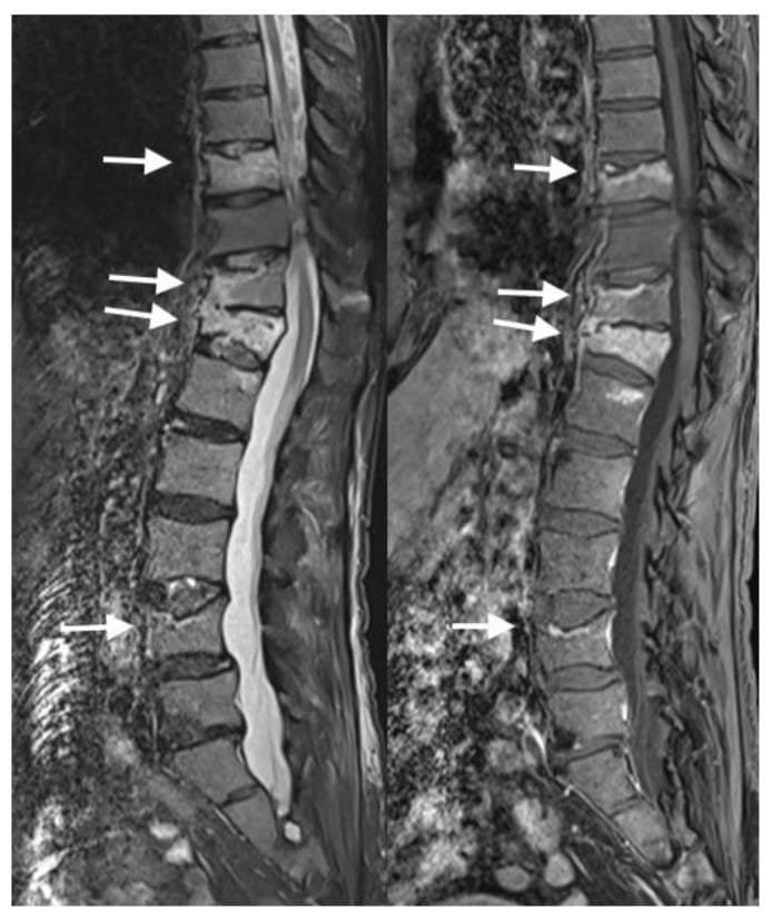 Investigation MRI showing multiple benign osteoporotic compression fractures with oedema and enhancement.