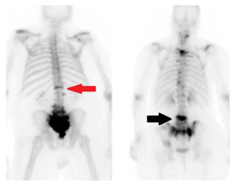 Investigation bone scans comparing linear vertebral uptake from a compression fracture with diffuse uptake from metastasis.