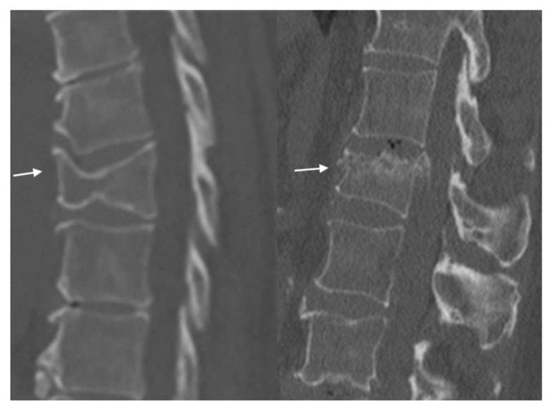 Sagittal CT comparison of a wedge compression fracture and a burst compression fracture.