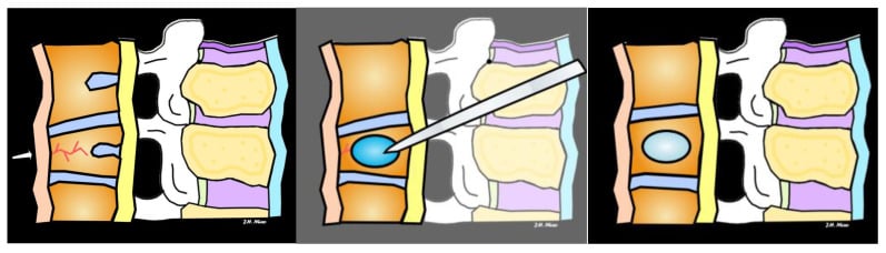 Surgical technique diagram of balloon kyphoplasty with cavity creation and PMMA filling.