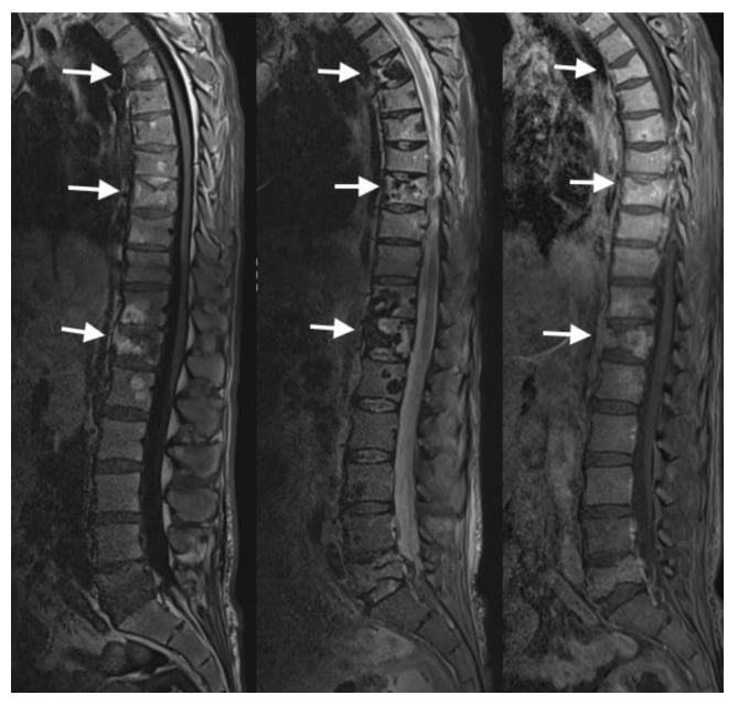 Investigation MRI showing diffuse metastatic marrow replacement and multilevel pathological compression fractures.