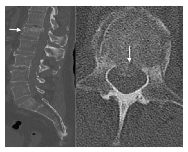 Sagittal and axial CT of a burst fracture showing posterior-wall retropulsion and canal narrowing.