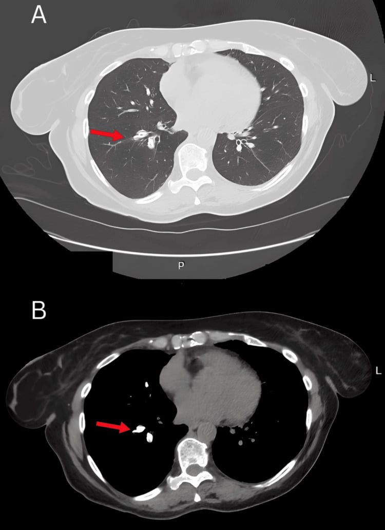 Complication chest CT showing hyperdense PMMA cement emboli in pulmonary arterial branches.