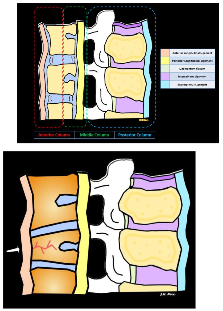 Anatomy diagram of the Denis anterior, middle and posterior spinal columns with a stable wedge compression fracture.