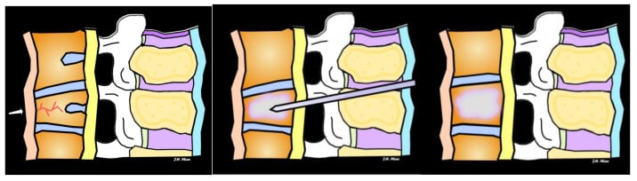 Surgical technique diagram of percutaneous vertebroplasty with trocar placement and PMMA injection.