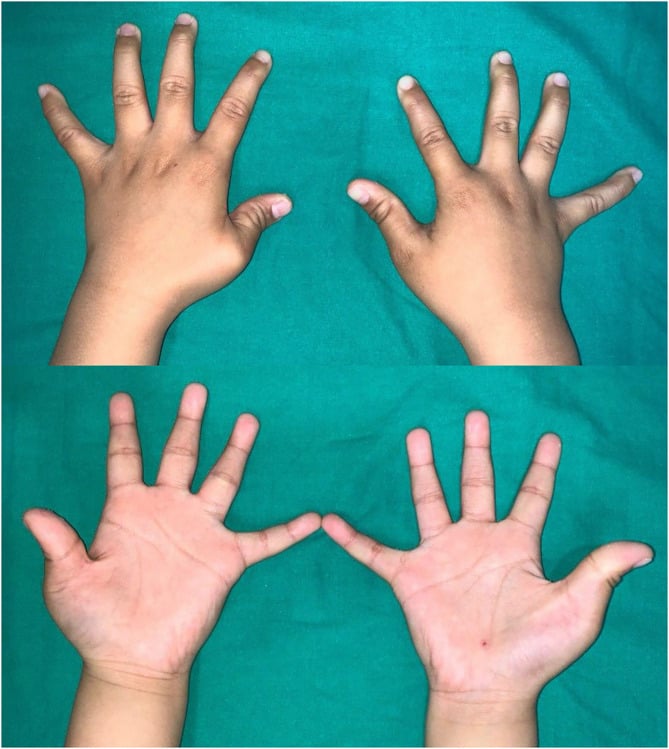 Clinical photograph of both hands showing bilateral congenital clasped thumb with flexion and adduction deformity