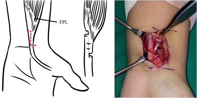 Line drawing schematic diagram and surgical photo of flexor pollicis longus Z-lengthening