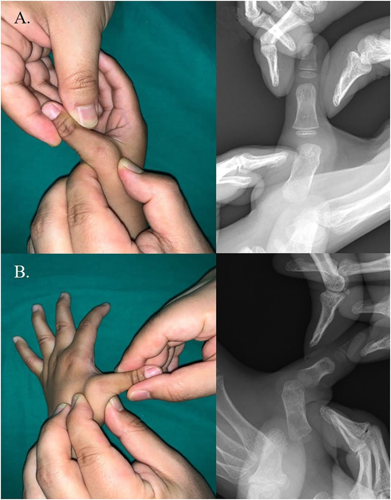 Clinical photographs and radiographs of the metacarpophalangeal joint stress test showing joint instability