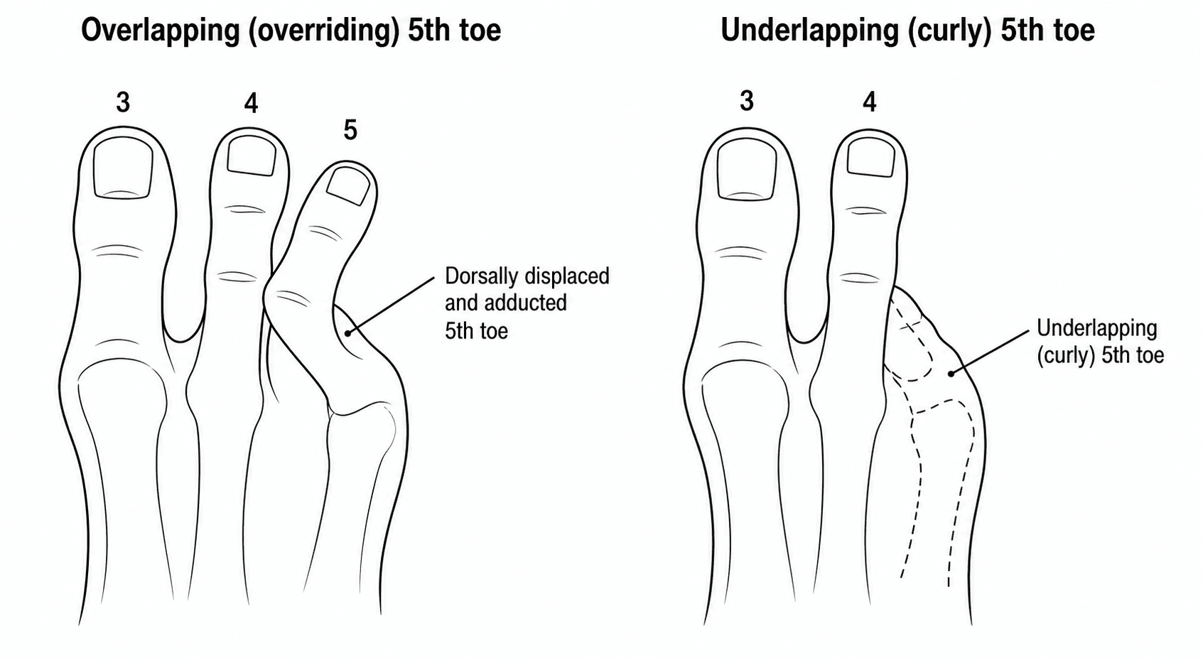 Diagram comparing the overlapping (overriding) fifth toe riding over the fourth toe with the underlapping (curly) fifth toe tucked beneath it