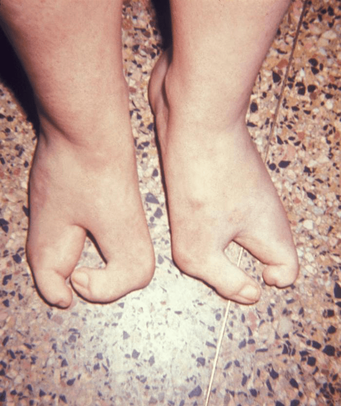 Photograph of a child’s feet showing bilateral cleft (lobster-claw) feet with absent central rays