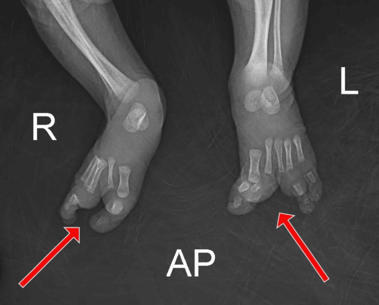 AP radiograph of both feet showing absent phalanges of the second and third rays on the left and the second ray on the right