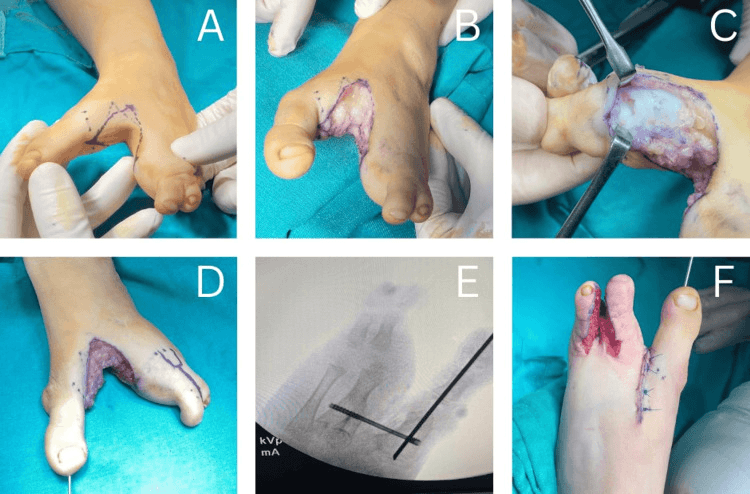 Sequential intraoperative photographs of cleft foot closure with a diamond incision, capsular repair and K-wire stabilisation
