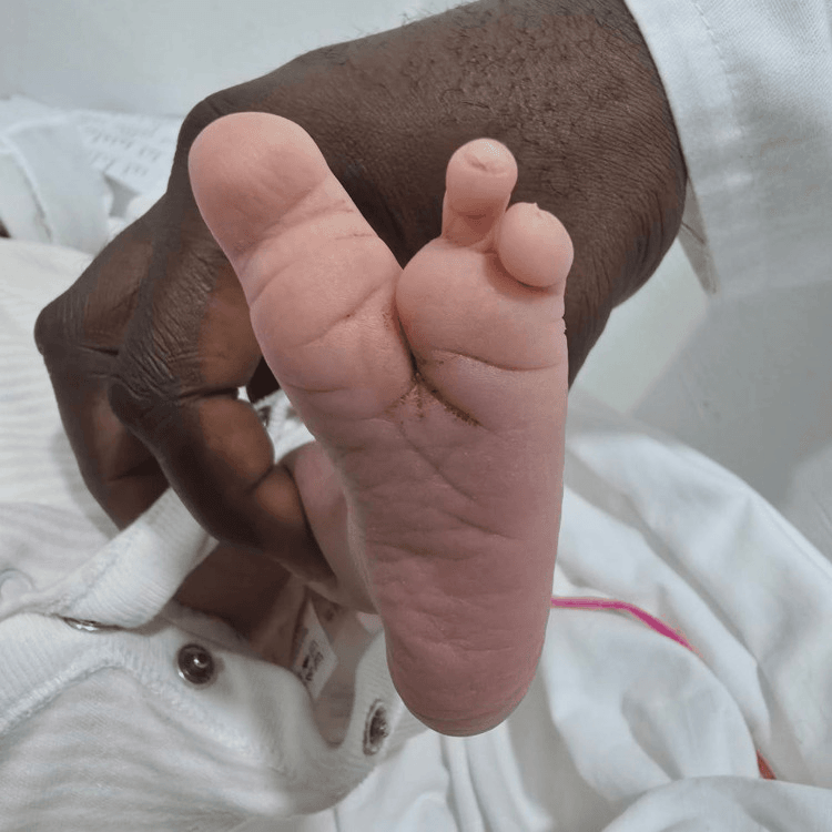 Clinical photograph of a left foot with absence of the second and third toes in ectrodactyly