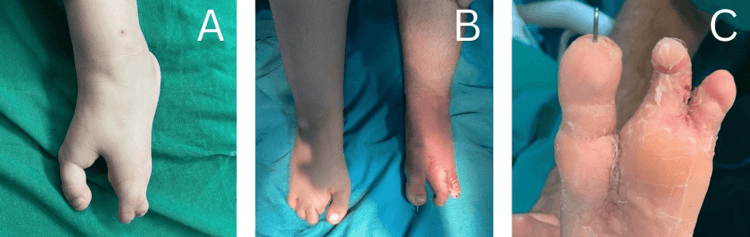 Preoperative and postoperative photographs of bilateral severe cleft feet after surgical correction