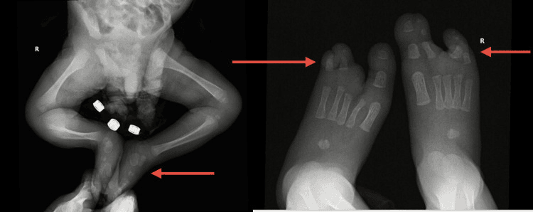 Lower-limb radiograph showing bilateral talipes equinovarus with central ray deficiency in a TP63-related ectrodactyly syndrome