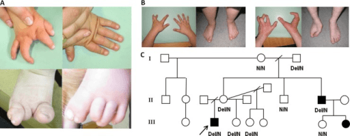 Photographs of hands and feet from split-hand/split-foot malformation families showing variable severity and incomplete penetrance
