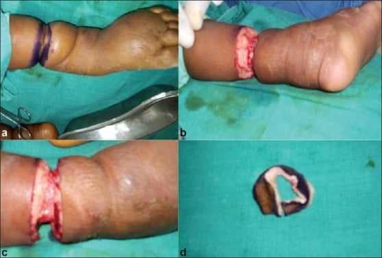 Surgical release of congenital constriction band showing pre-operative marking, intraoperative release, and excised specimen