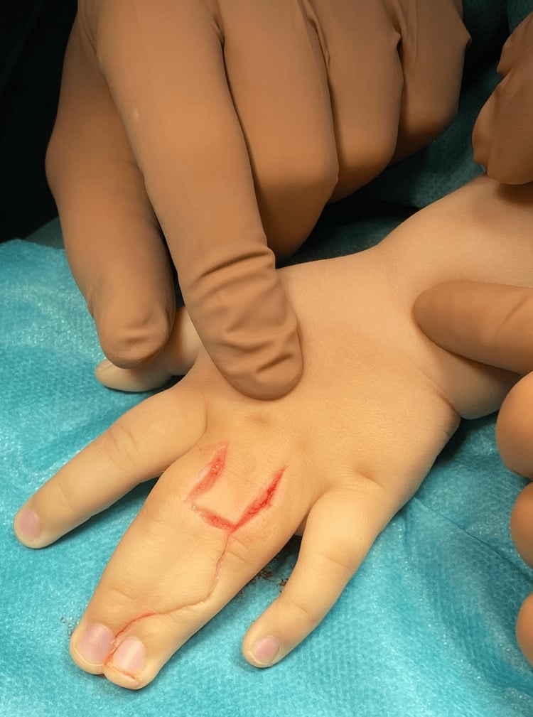 Preoperative dorsal markings for digital separation with Z-plasty design for web space reconstruction