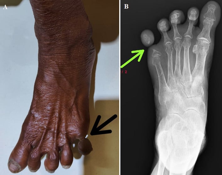 Clinical photograph and radiograph of ainhum showing a spontaneous constricting groove at the base of the fifth toe with bone resorption