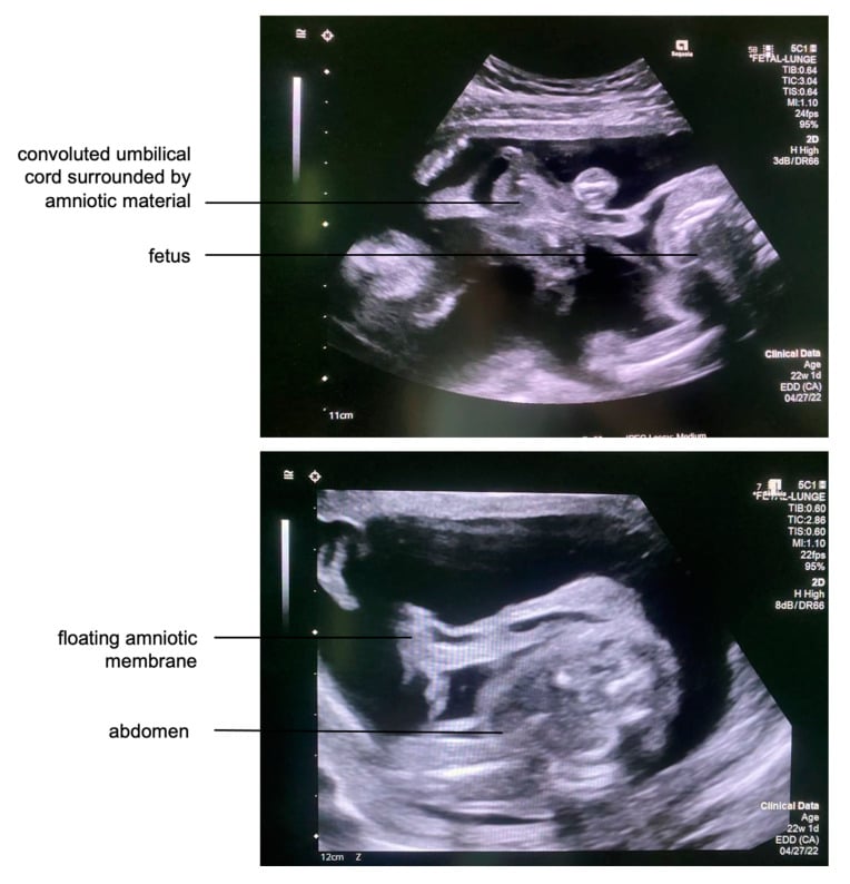 Transabdominal fetal ultrasound showing membranous strands encircling the umbilical cord with floating amniotic membrane adjacent to the fetus