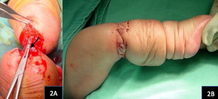 Intraoperative photograph of a deep fibrous constricting band being excised, with the limb after Z-plasty closure showing reduced oedema